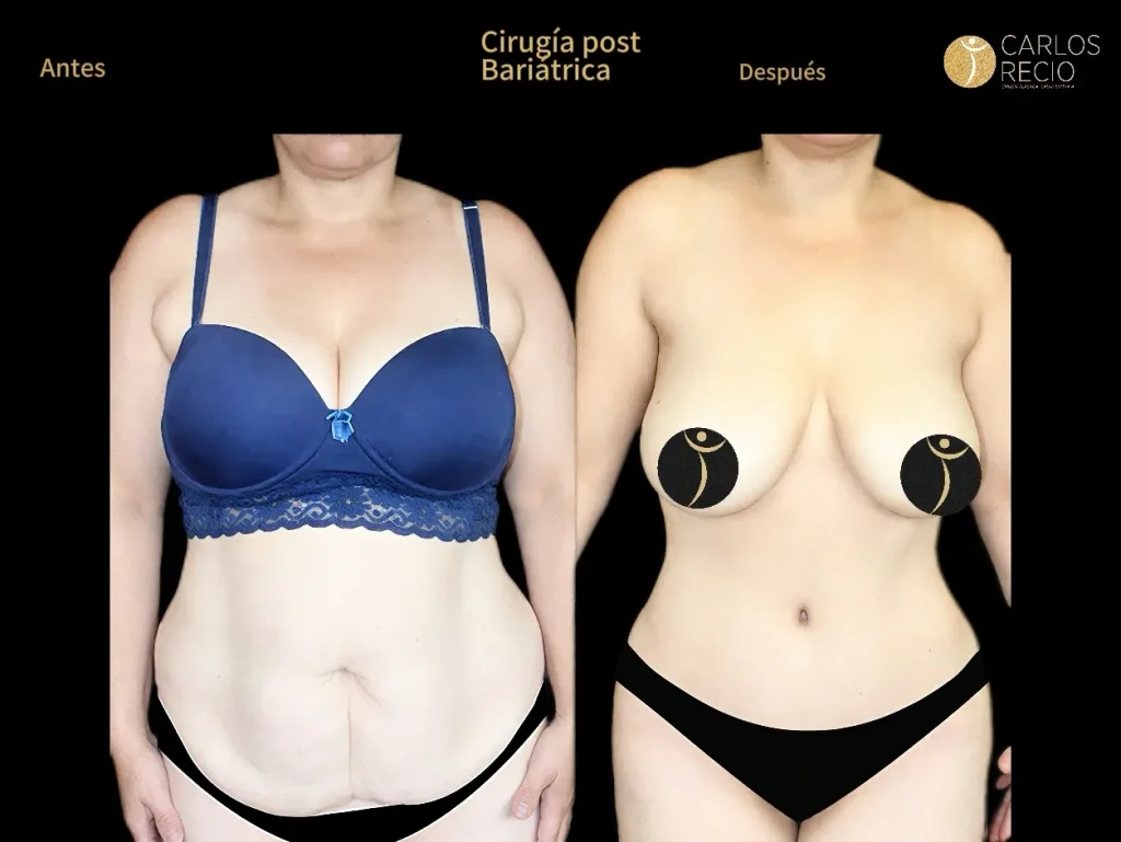 Cirugía reconstructiva post bariátrica: qué hacer con la piel sobrante Cirugía reconstructiva post bariátrica: qué hacer con la piel sobrante